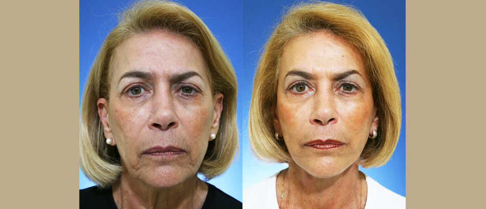 Boca facial plastic raton surgery