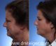 plastic raton facial surgery Boca