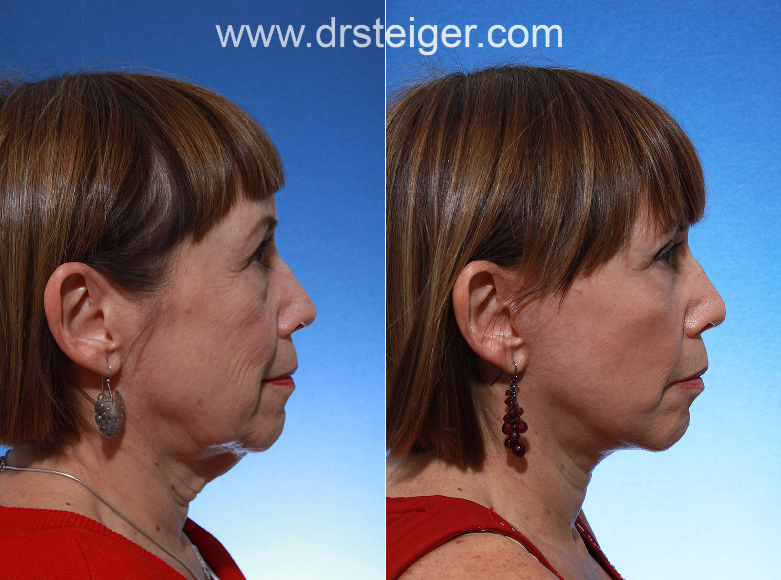 Facelift surgery with eyelid surgery photos
