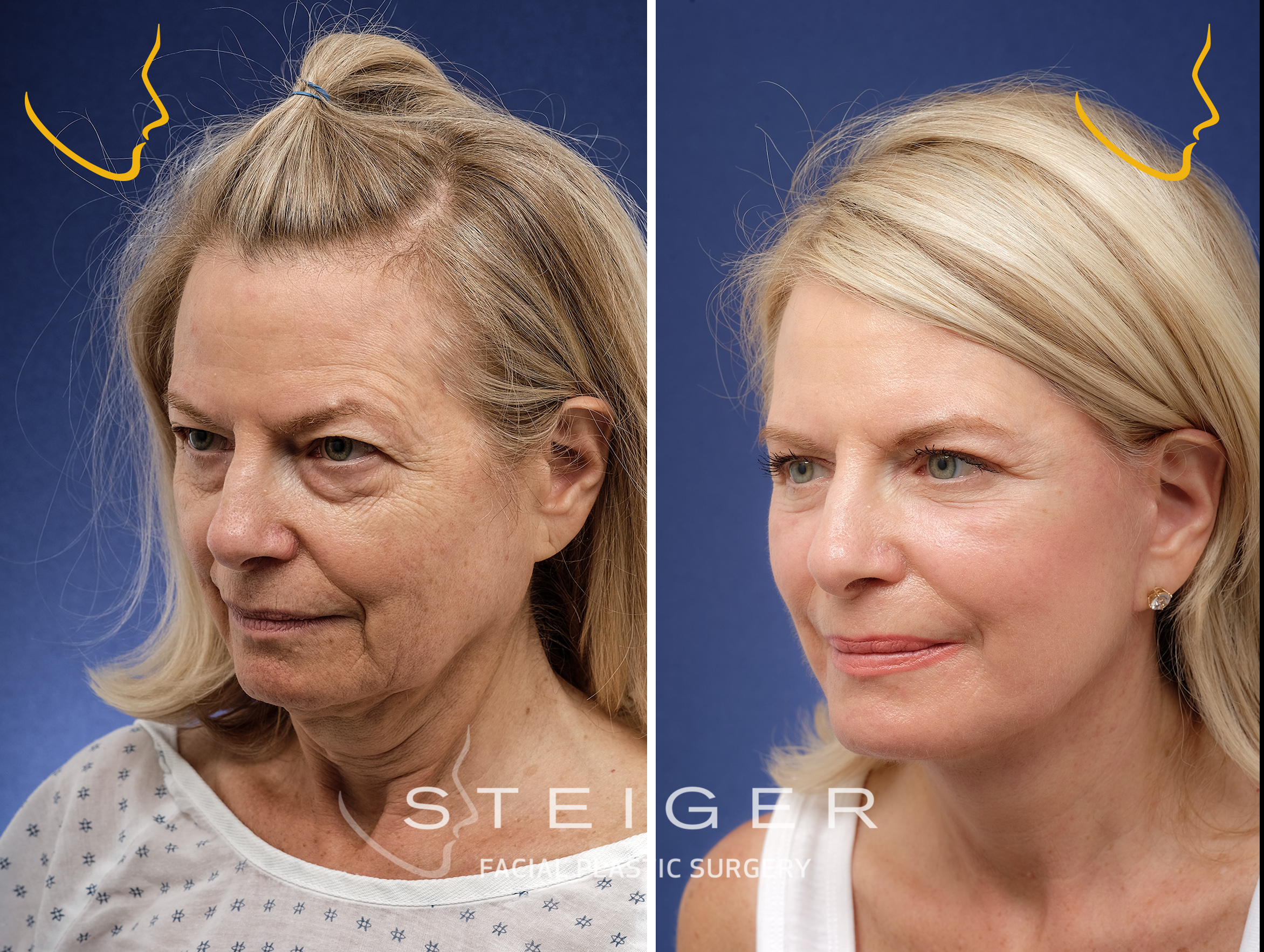 facelift in Boca Raton 