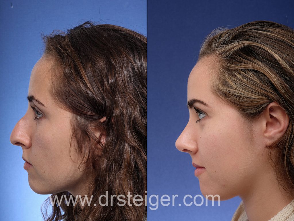 Rhinoplasty Before and After Photos