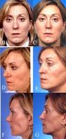 Before and after photos of an augmentation revision rhinoplasty