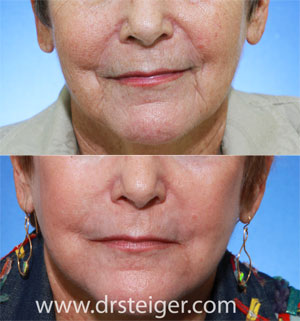 artefill-before-and-after