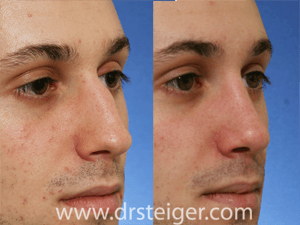 before and after rhinoplasty for a hump