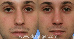 before and after rhinoplasty for a crooked nose