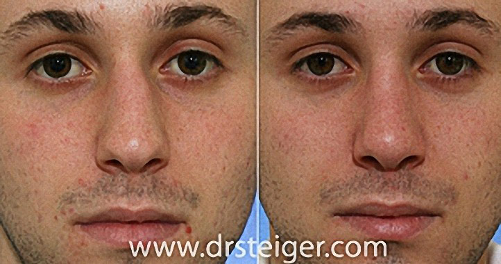 before-after-rhinoplasty-crooked-nose1