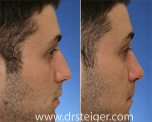 before and after rhinoplasty for a nasal hump