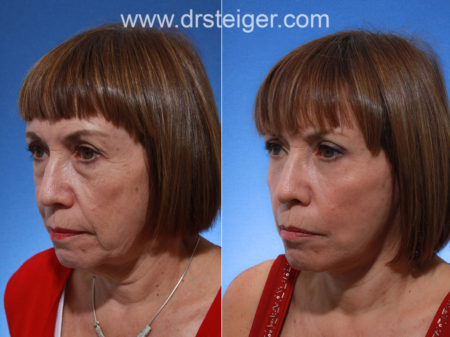 before and after deep plane facelift photos