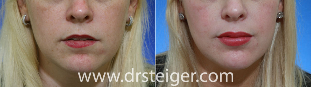 before-and-after-lip-enhancement