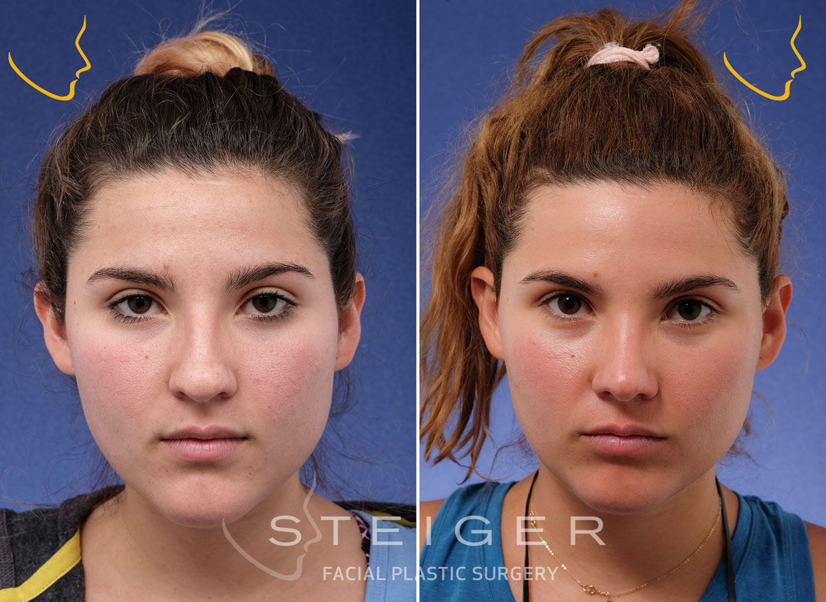 Rhinoplasty Advanced Nose Job Specialist in Boca Raton Florida