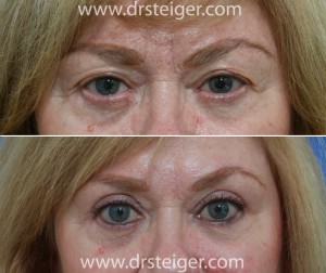 blepharoplasty-before-and-after-photo