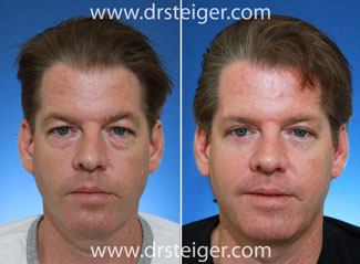 male eyelid surgery before and after photo