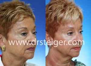 blepharoplasty-with-fat-grafting