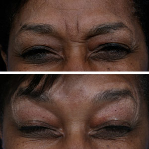 Botox Before & After Photos, Patient Photo, Pictures