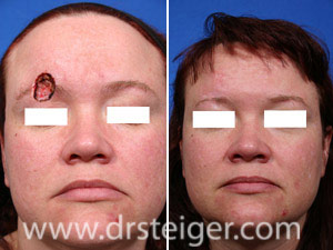 mohs surgery after reconstruction eyebrow before flap repair goals drsteiger