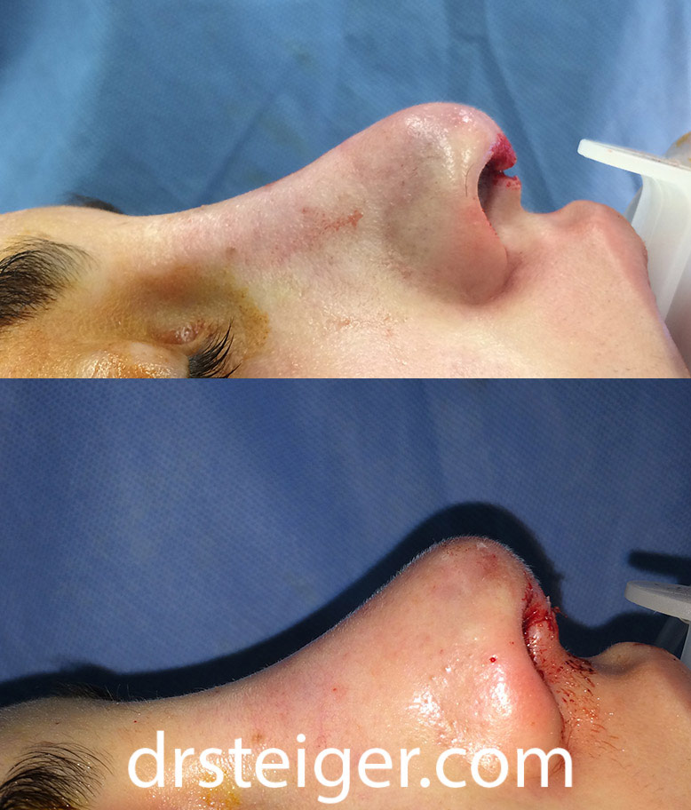 Caudal Extension Graft before and after