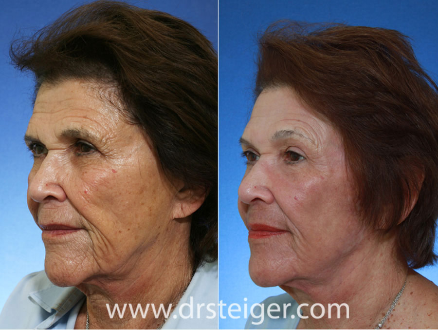 CO2 Laser Treatment Before & After