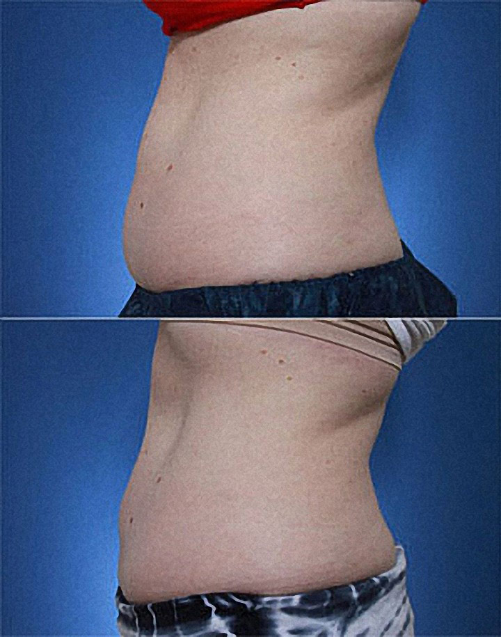 Coolsculpting Before and After Photos