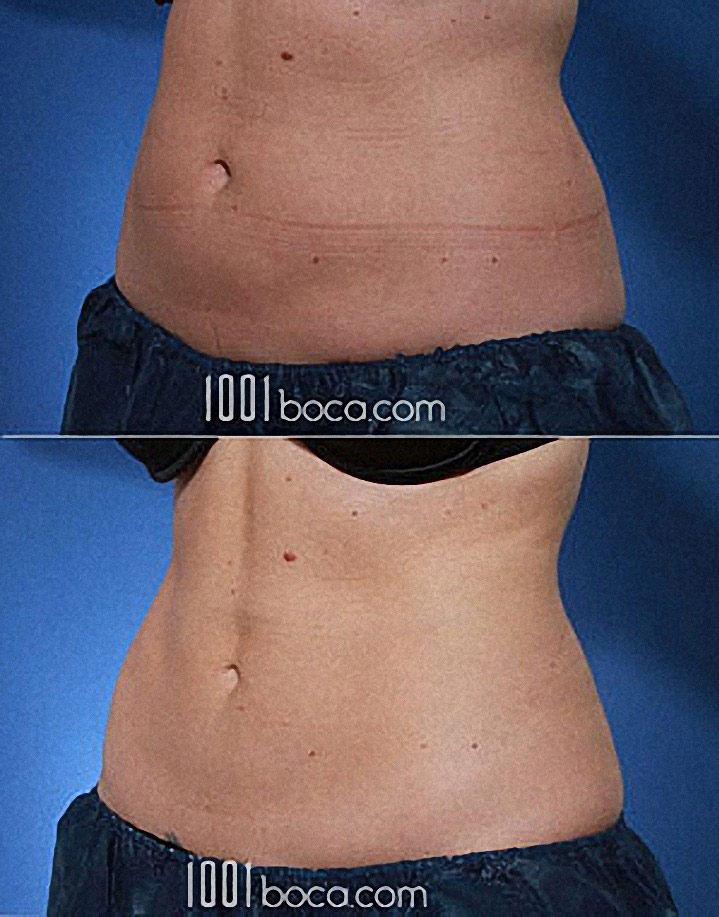 Coolsculpting for Belly Fat Reduction