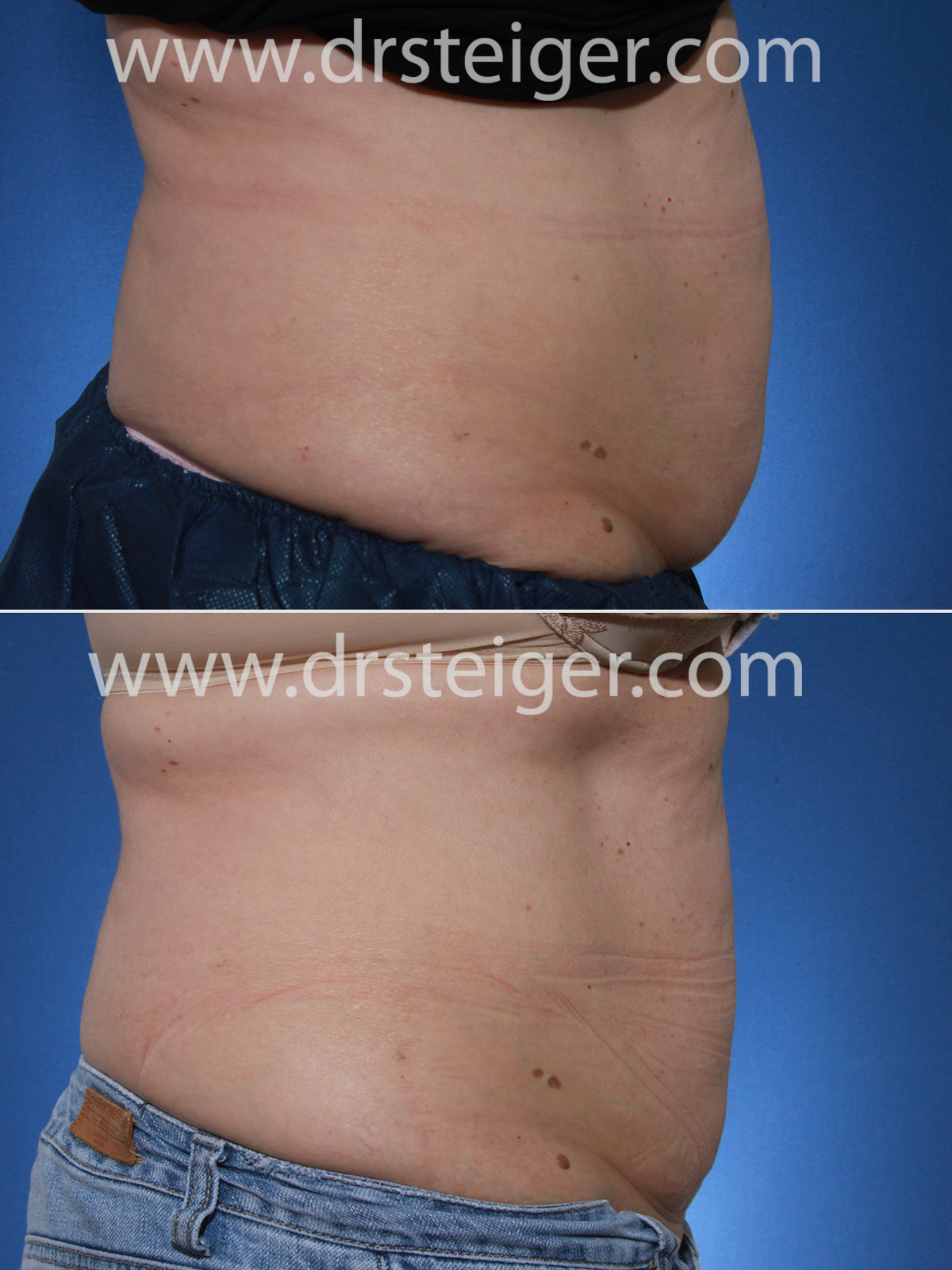 belly fat before and after