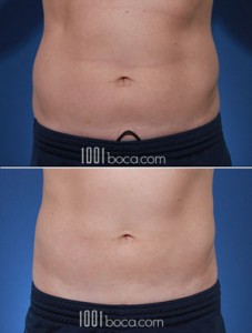 coolsculpting-love-handle-pictures