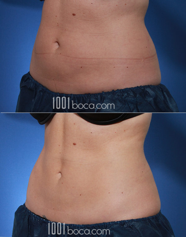 Belly Fat Freezing with CoolSculpting, CoolSculpting Stomach/Abdomen Before  and After photos