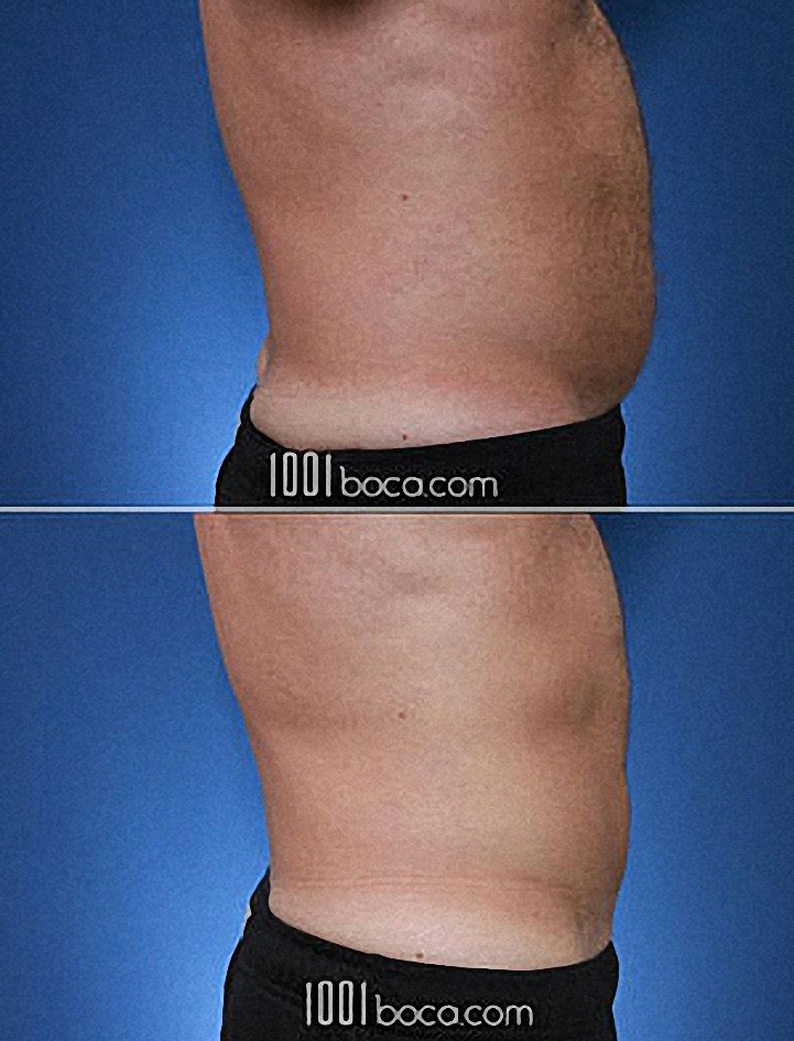 Coolsculpting the Belly of a Man