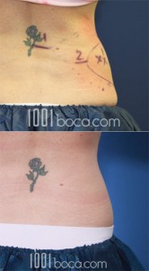 coolsculpting-muffin-top