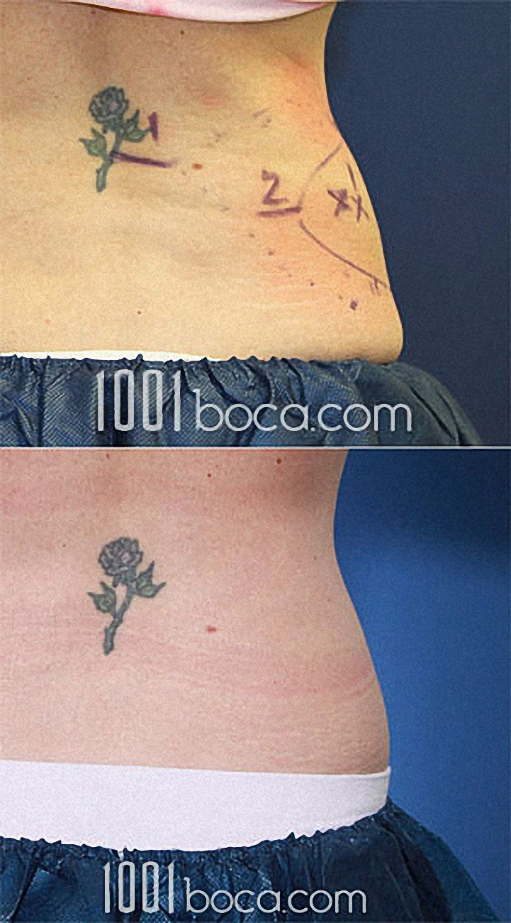 Coolsculpting of the Muffin Top