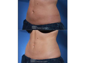 Coolsculpting belly fat removal
