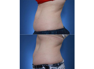 coolsculpting stomach fat