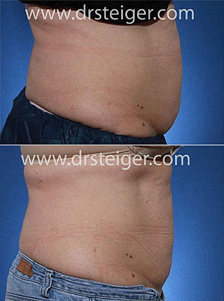 Coolsculpting the Lower Abdomen