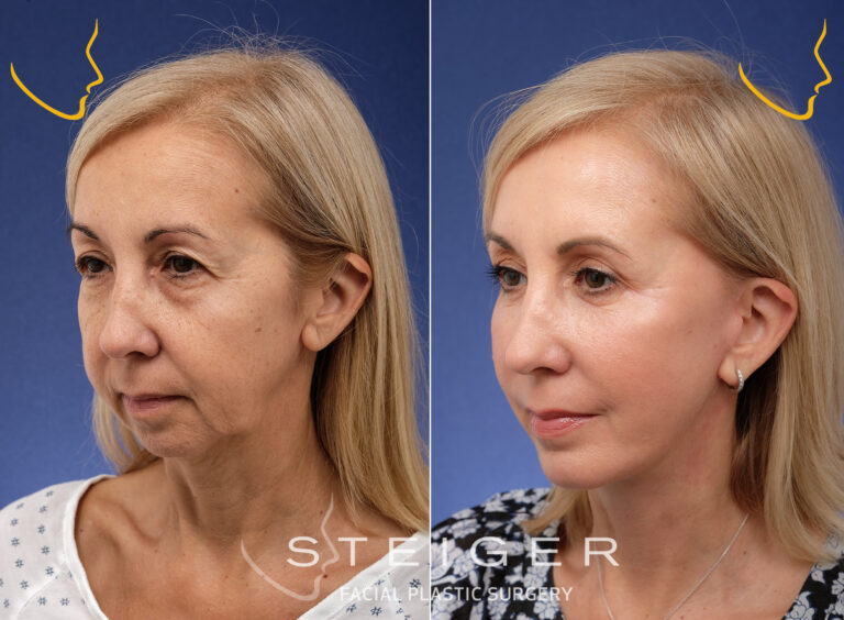 Facelift Before and After Photos | Deep Plane Facelift