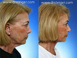deep-plane-facelift-results1