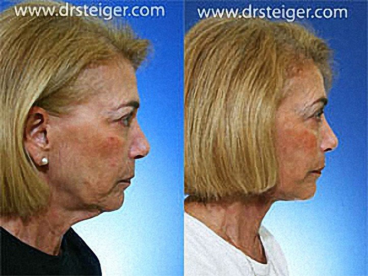 Deep Plane Facelift Results