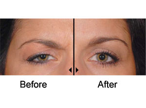 dysport eyebrow lift