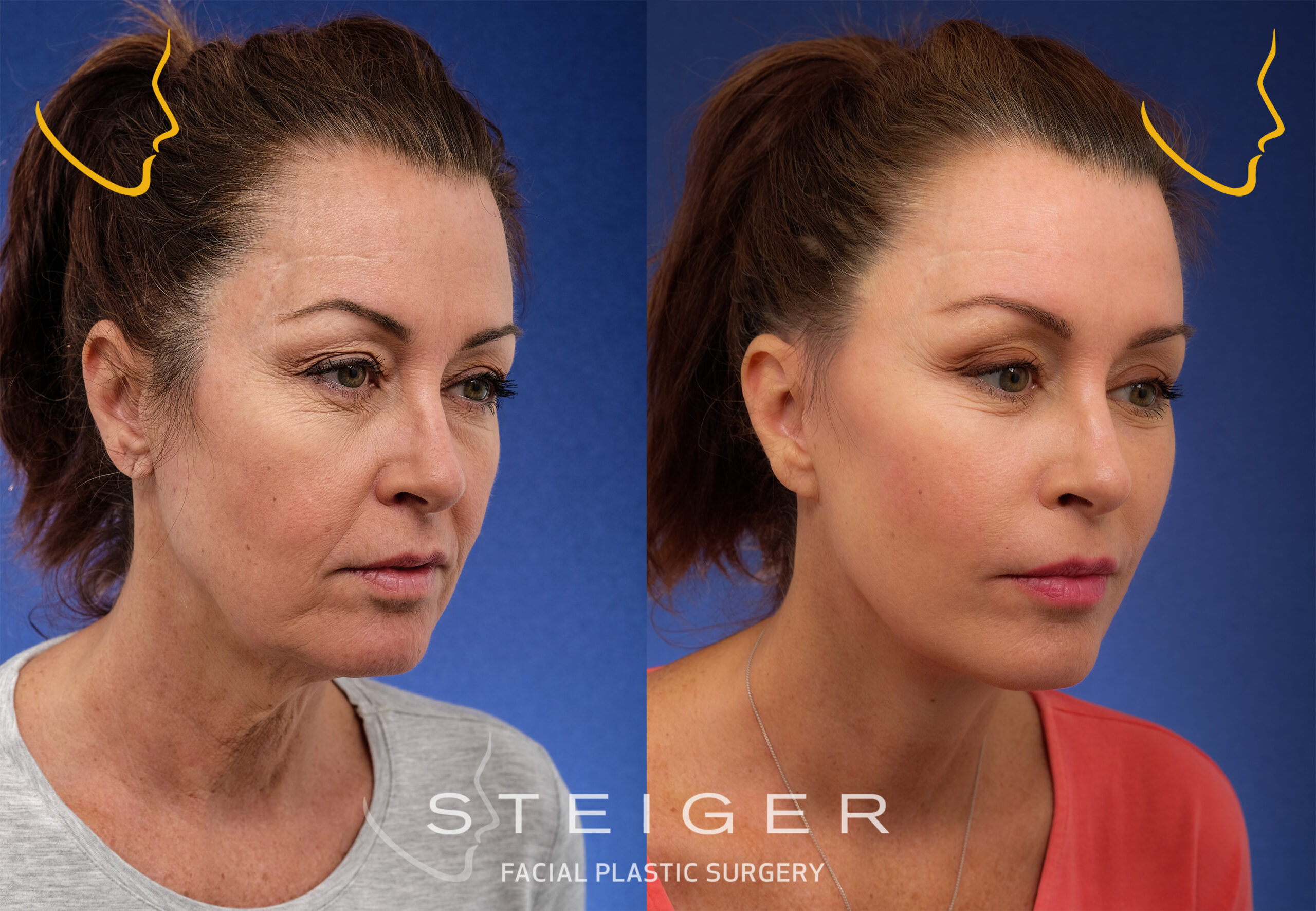 Facelift Before and After Photos | Deep Plane Facelift