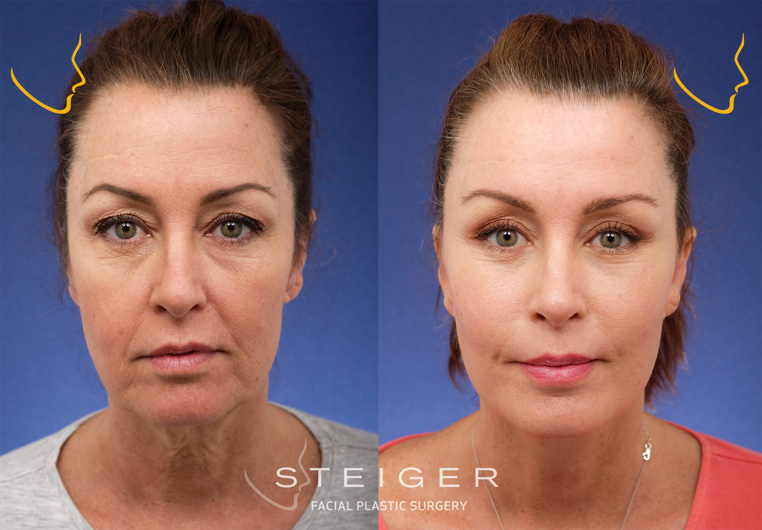Does Facelift Surgery Gives You a Wrinkle Free Face?