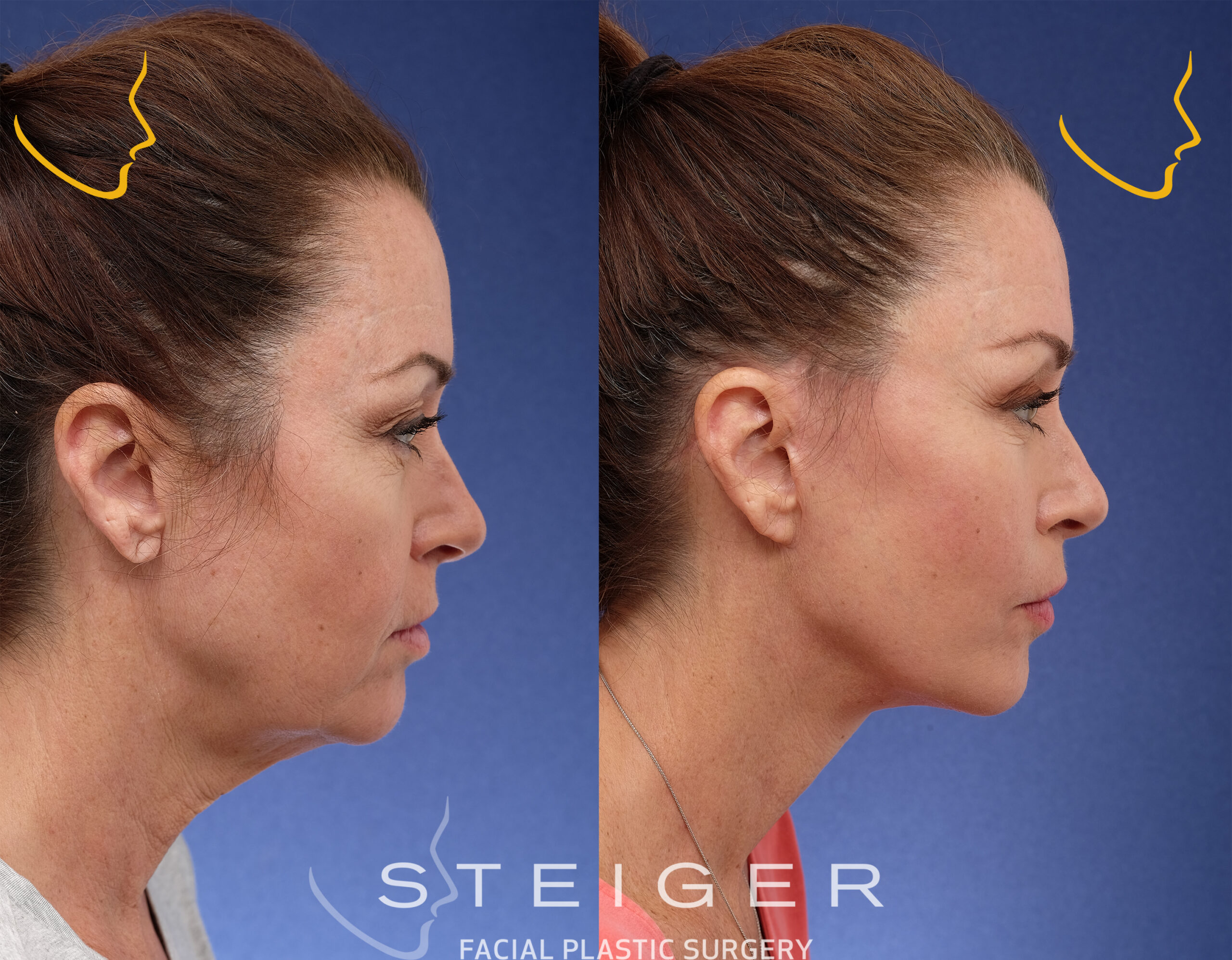 Facelift Insta0oct Scaled 