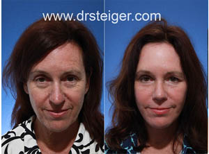 facelift with a nose job
