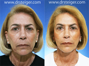 facelift-photo-before-and-after
