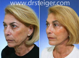 facelift before and after photos south florida