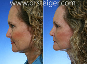 facelift and necklift photos