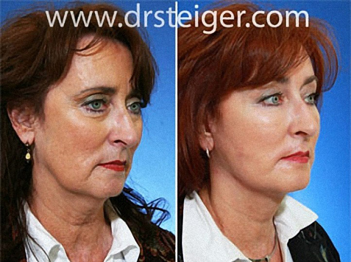 facelift-with-fat-grafting-photos1