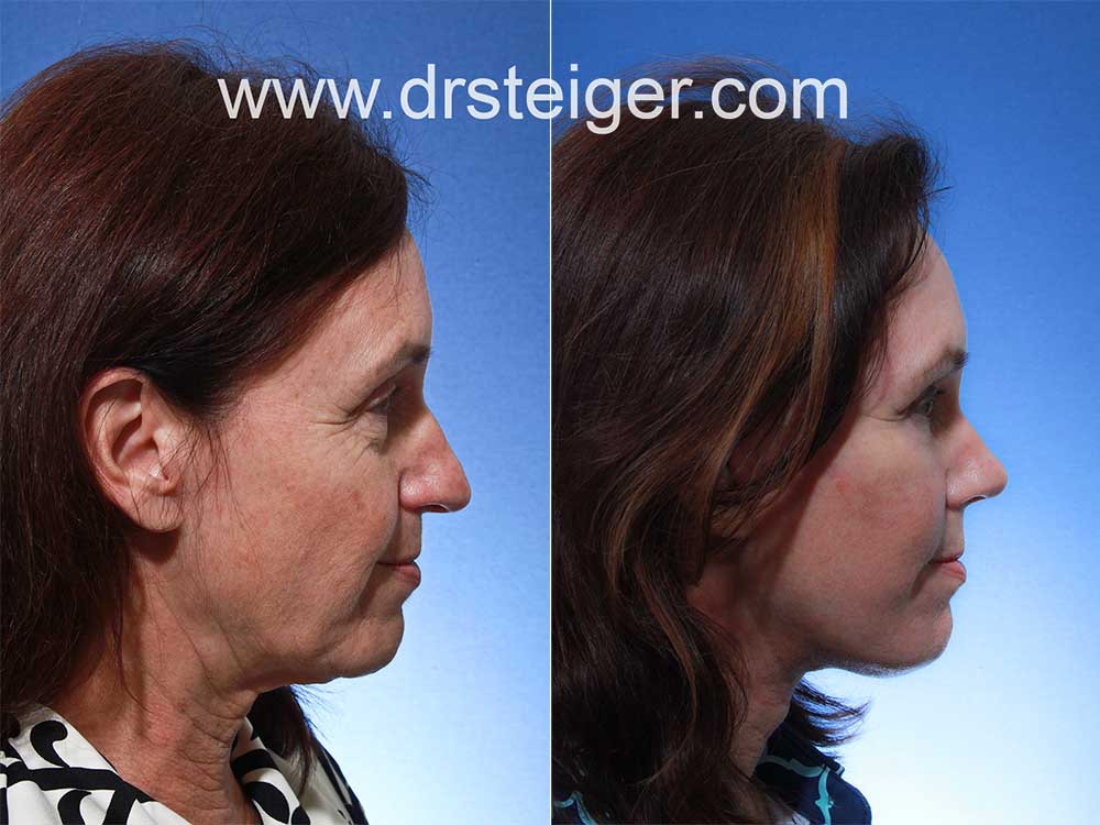facelift with rhinoplasty
