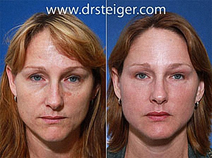 facial fat grafting photos