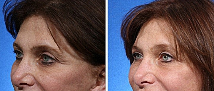 Fat Transfer Around the Eyes