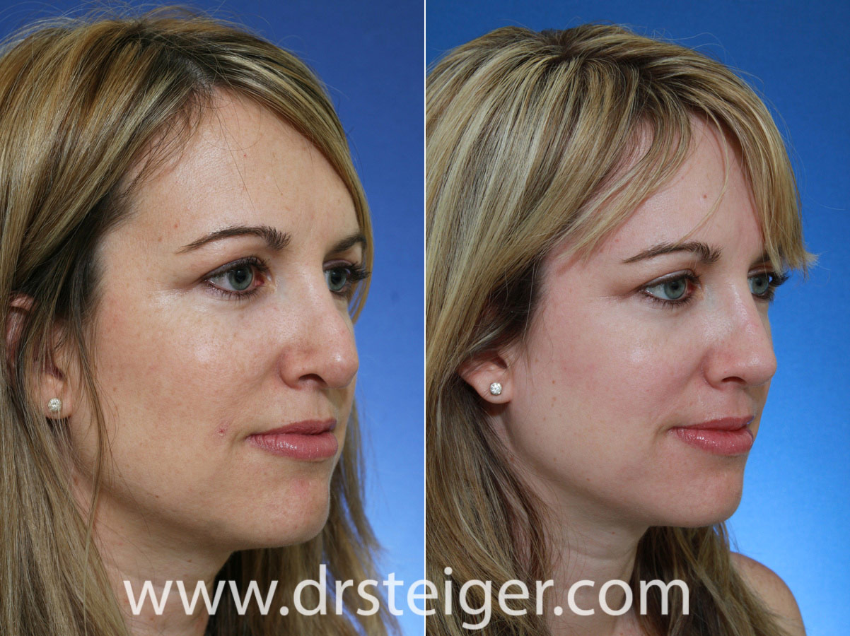 bad rhinoplasty before and after