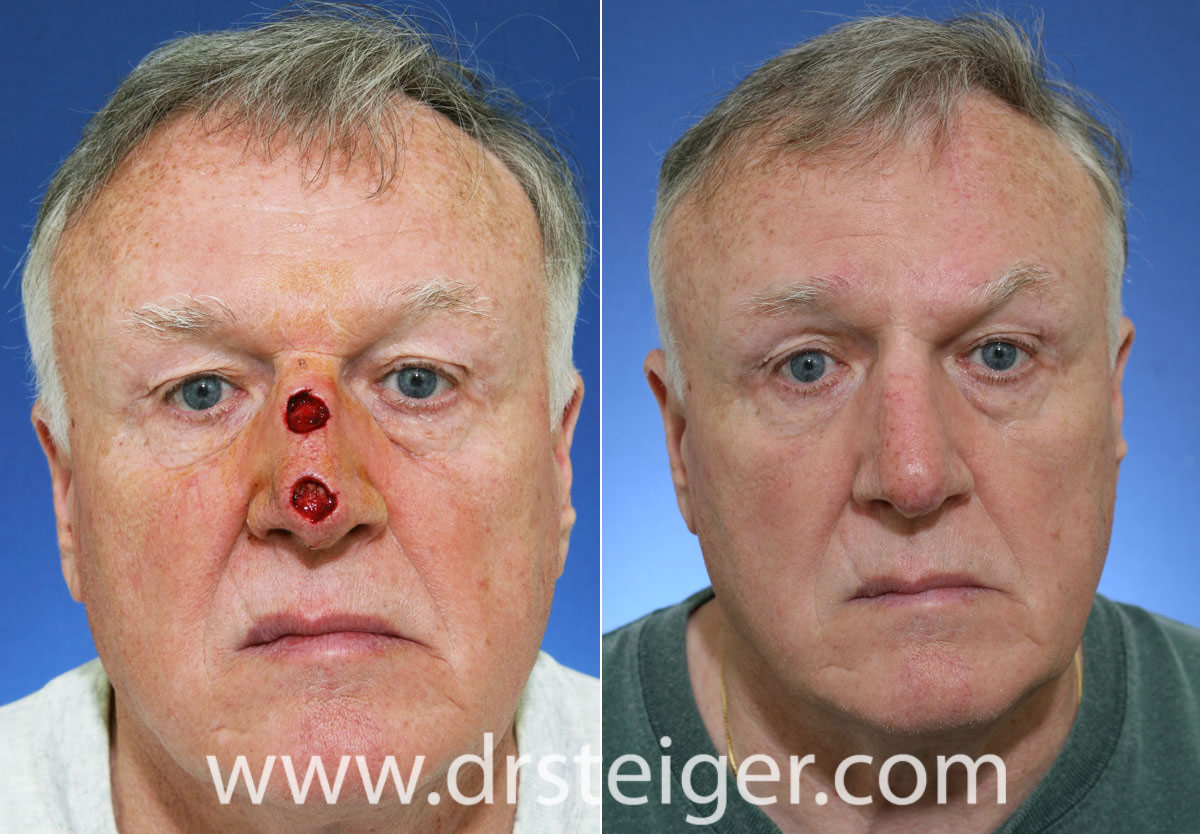 Forehead Flap Nose Before And After Steiger Facial Plastic Surgery