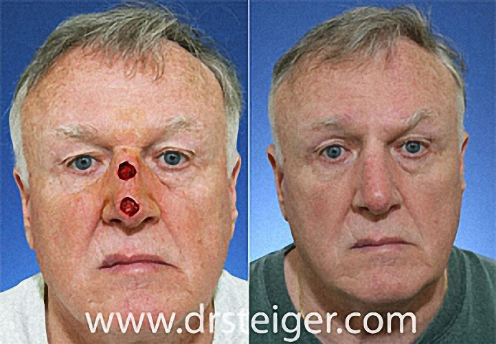 Forehead Flap for Nasal Reconstruction